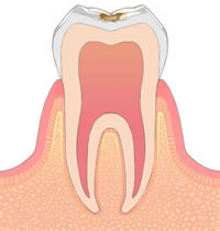 C1：歯の表面のエナメル質が溶け始めた状態 