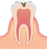 C2：エナメル質の内側、象牙質まで進行している状態 