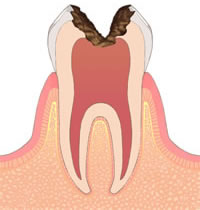 C3：虫歯が象牙質の内側の歯髄に達した状態