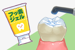 虫歯の予防処置