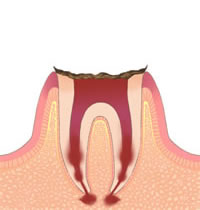 C4：歯冠が溶けて無くなった状態