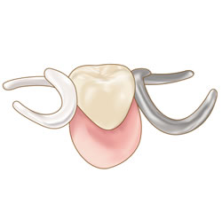 部分入れ歯