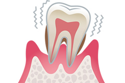 歯周病になってしまう原因・メカニズム