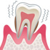 歯周病治療