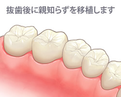 歯の移植とは